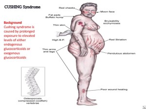 Cushing’s disease