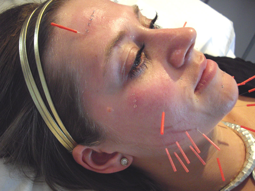 Cosmetic Acupuncture